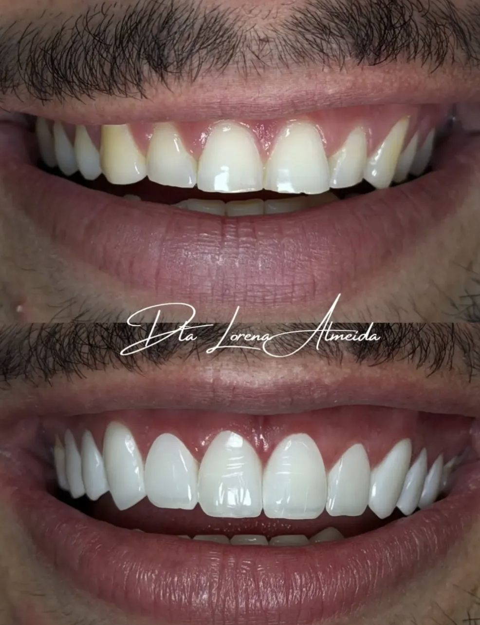 Resultado real de facetas em resina — antes e depois, trabalho da Dra. Lorena Almeida